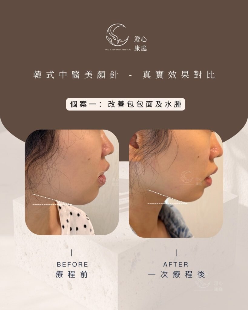 韓式美顏針改善包包面前後效果對比圖