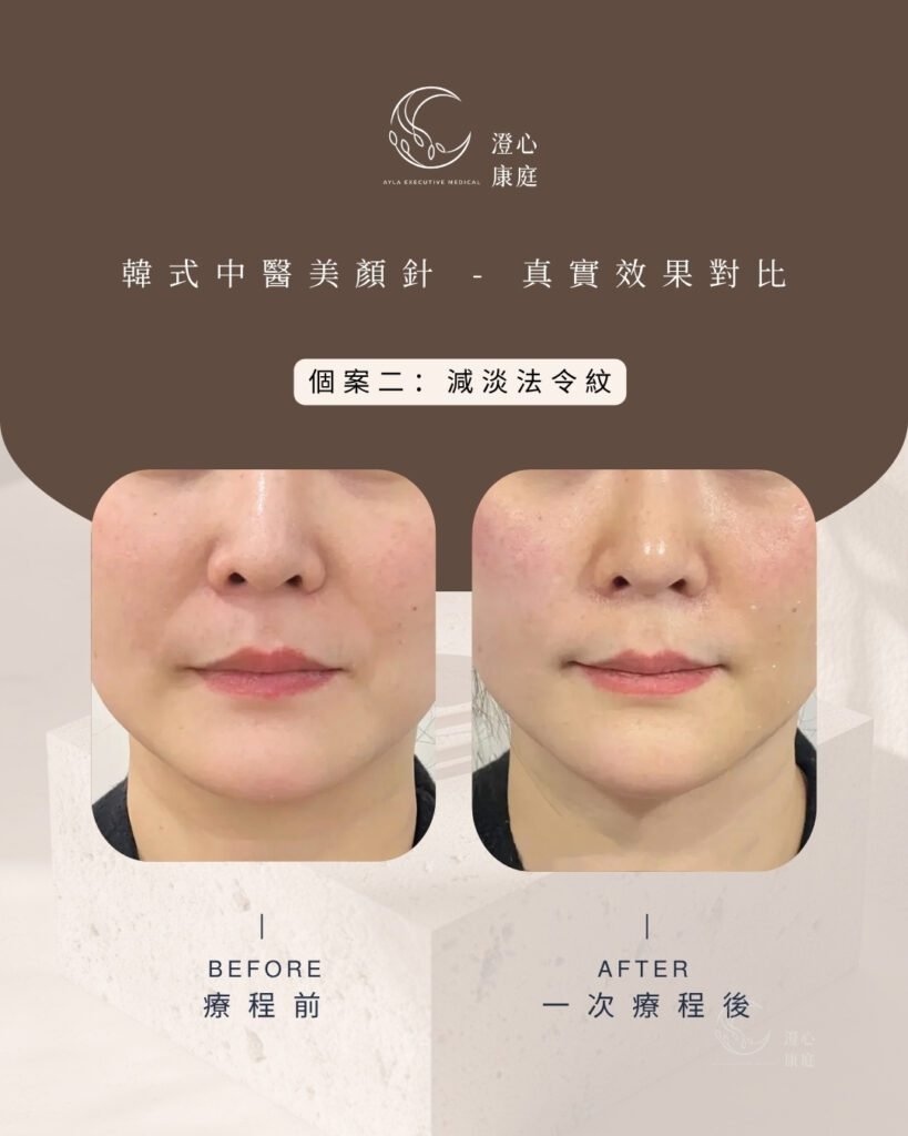 韓式美顏針減淡法令紋前後效果對比圖