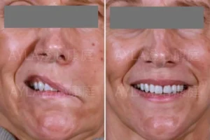 bell's palsy周圍性面癱before and after 3