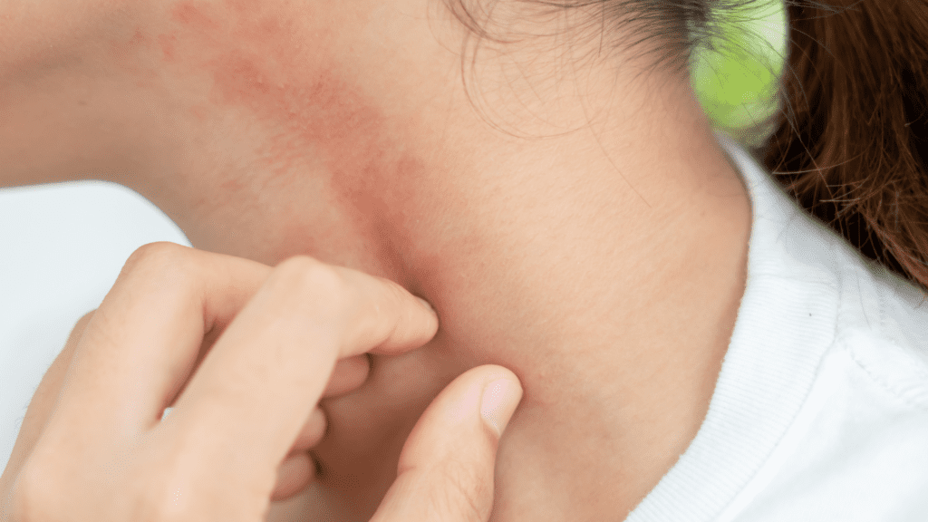 一隻手塗抹草本藥膏於泛紅的皮膚上，背景為潮濕的窗戶水珠，代表回南天皮膚敏感急救 — Ayla Executive Medical