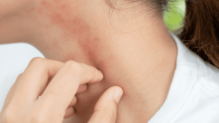 一隻手塗抹草本藥膏於泛紅的皮膚上，背景為潮濕的窗戶水珠，代表回南天皮膚敏感急救 — Ayla Executive Medical