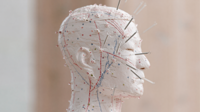 Anatomical acupuncture model of the head with meridian lines and filiform needles, illustrating clinical acupuncture for headache treatment at Ayla Executive Medical 澄心康庭