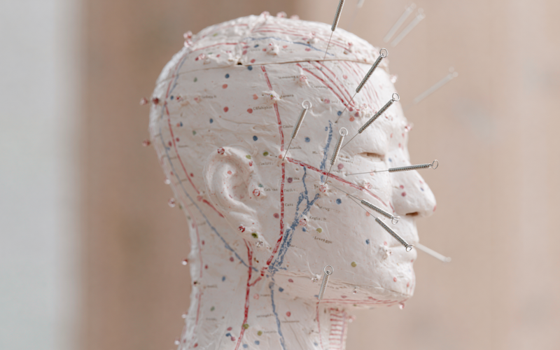 Anatomical acupuncture model of the head with meridian lines and filiform needles, illustrating clinical acupuncture for headache treatment at Ayla Executive Medical 澄心康庭